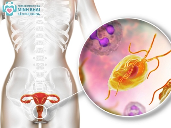 Các biến chứng của bệnh Trichomonas