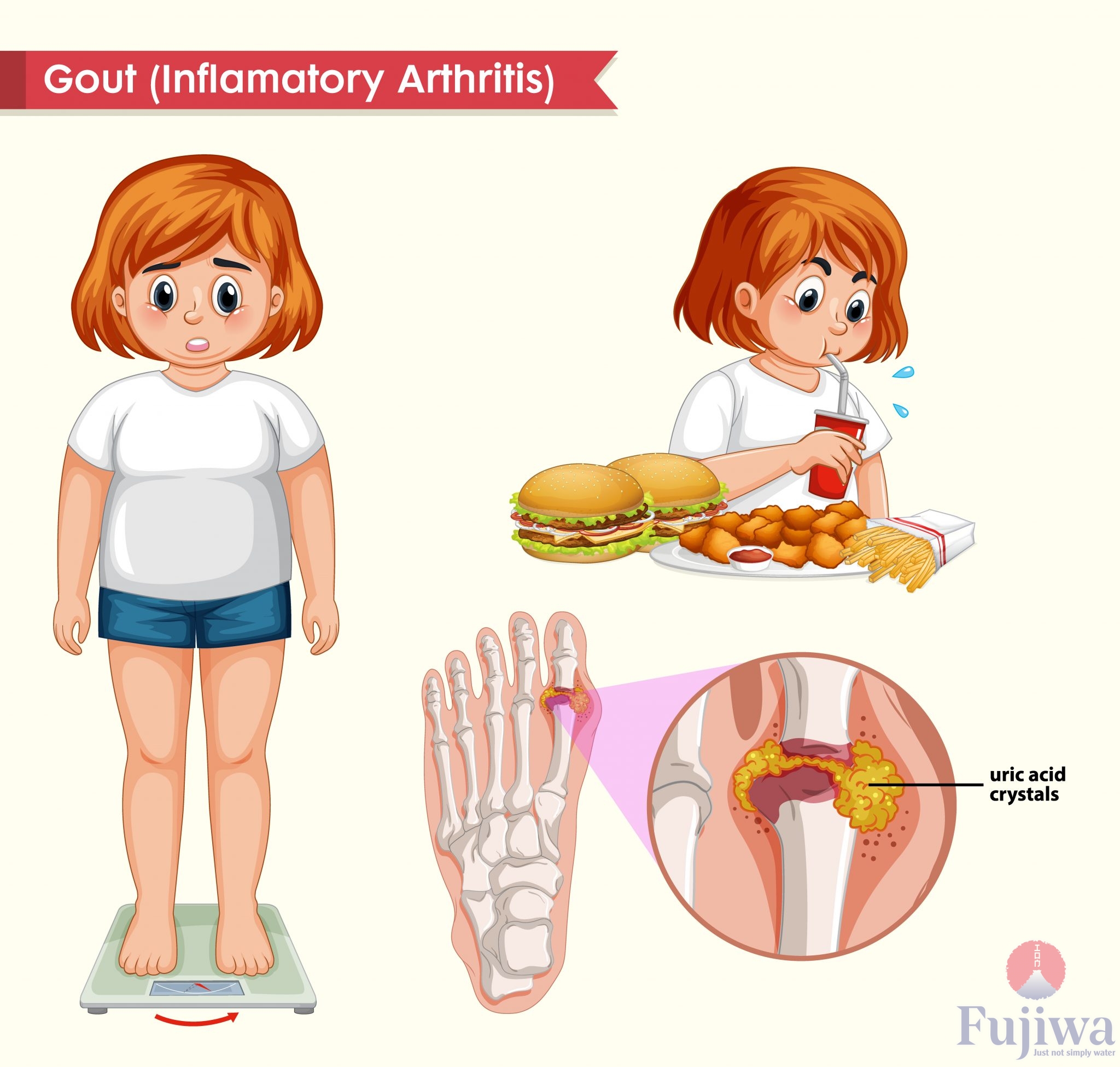 Tác dụng của nước ion kiềm trong việc hỗ trợ điều trị bênh gout