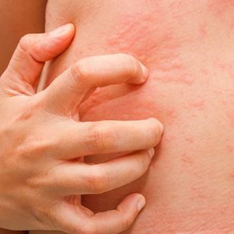 Mày đay hậu COVID-19, chữa thế nào ?