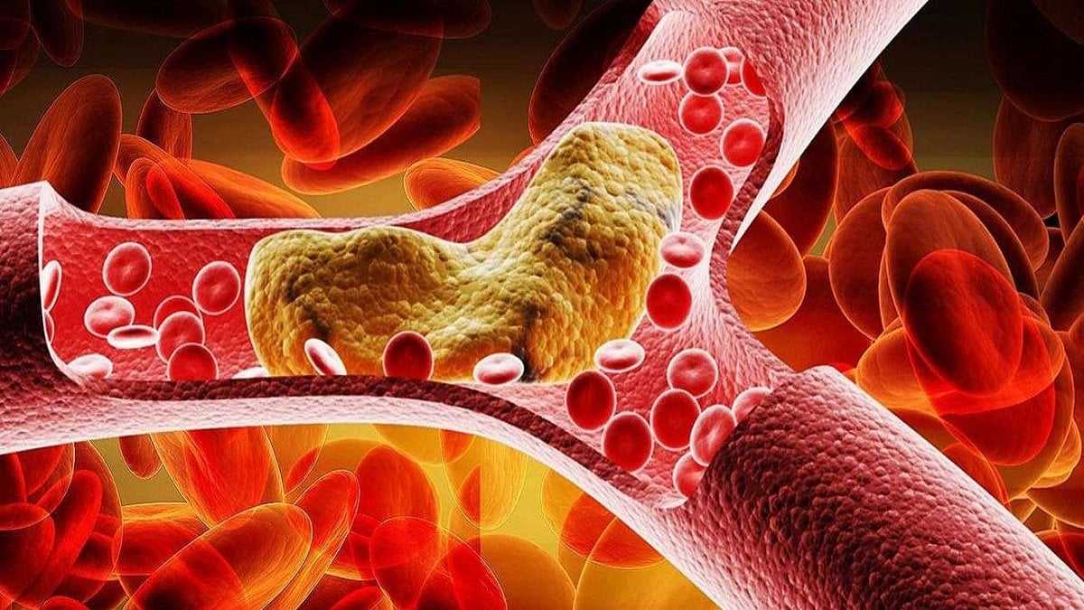 Mỡ máu cao có gây đột quỵ không? Nguyên nhân và cách phòng ngừa hiệu quả