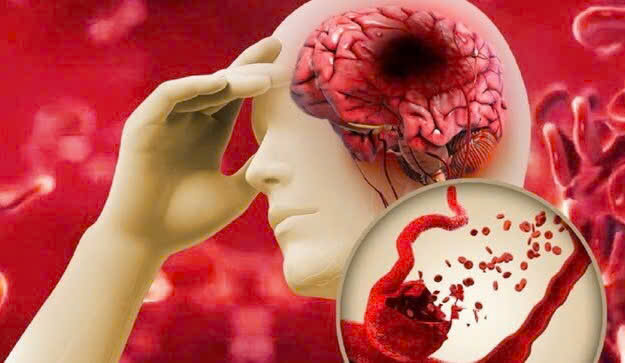 Tuổi nào nên tầm soát đột quỵ? – Chuyên gia cảnh báo đừng chủ quan