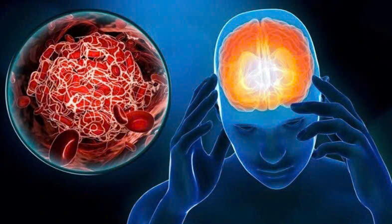 5 Loại Thức Uống Giúp Ngăn Ngừa Đột Quỵ Hiệu Quả Từ Thiên Nhiên