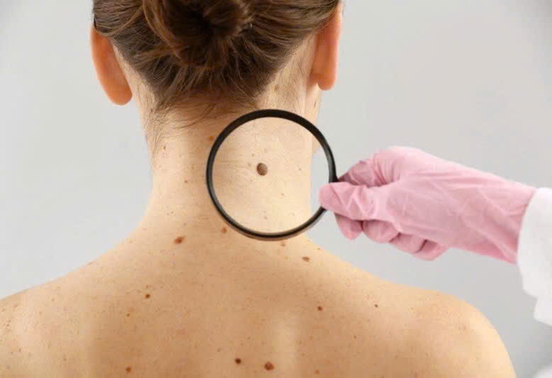 Những vị trí khó ngờ có thể bị ung thư da – Đừng chủ quan với những vùng da “ít để ý”