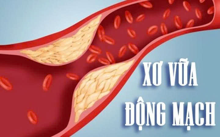 4 Thức Uống Hỗ Trợ Ngừa Xơ Vữa Động Mạch, Tăng Lưu Thông Máu Hiệu Quả