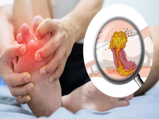 5 Biểu Hiện Trên Da Cảnh Báo Axit Uric Cao – Đừng Chủ Quan Với Những Dấu Hiệu Này!