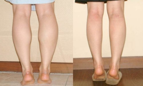 YẾU TỐ NÀO QUYẾT ĐỊNH ĐẾN HÌNH DÁNG CỦA ĐÔI CHÂN