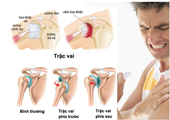 5 NHÂN TỐ GÂY CHẤN THƯƠNG VAI NGHIÊM TRỌNG VÀ CÁCH XỬ LÝ