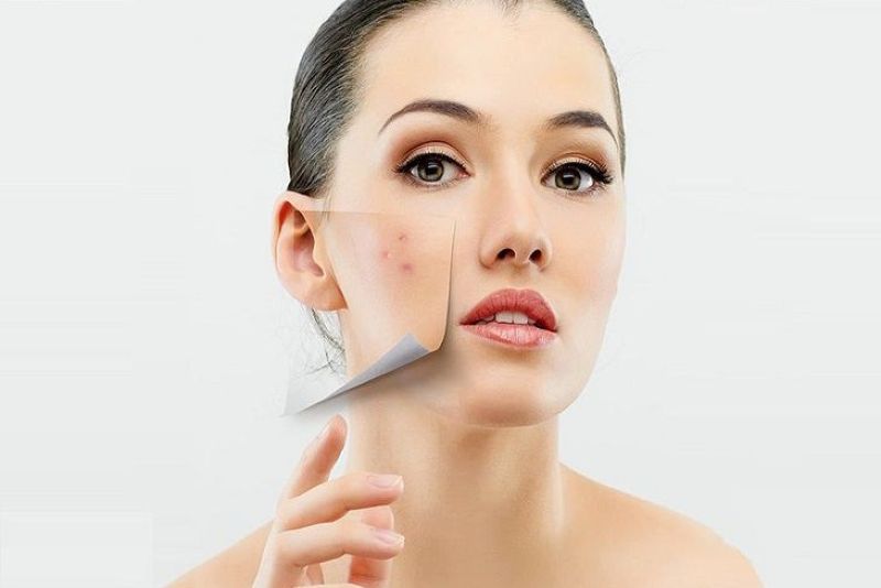 Bật mí cách chăm sóc da mụn hiệu quả bạn nên biết