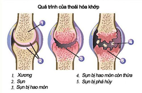 Top 7 Cách Bảo Vệ Khớp Và Ngăn Ngừa Thoái Hoá Khớp Hiệu Quả