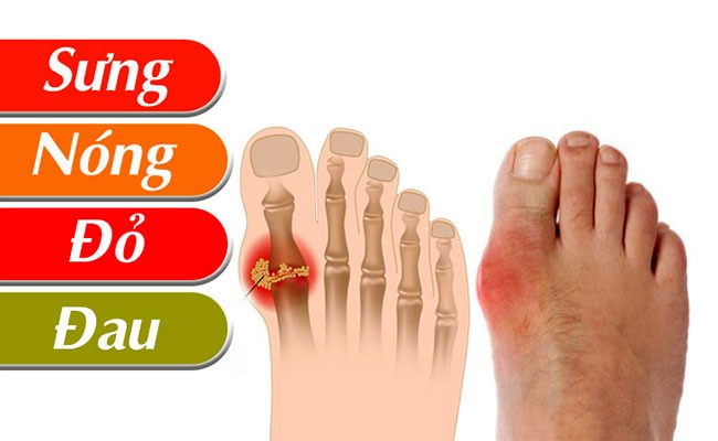 Cách điều trị bệnh Gout hiệu quả? Cách điều trị bệnh Gout hiệu quả? Những biến chứng nguy hiểm Cách điều trị bệnh Gout hiệu quả? Cách điều trị bệnh Gout hiệu quả? Những biến chứng nguy hiểm