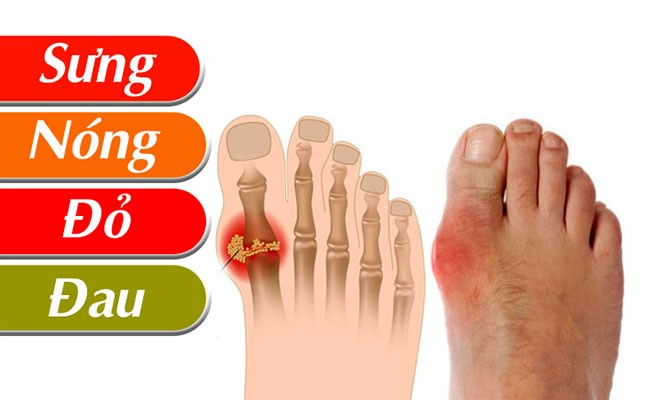 Cách điều trị bệnh Gout hiệu quả? Cách điều trị bệnh Gout hiệu quả? Những biến chứng nguy hiểm