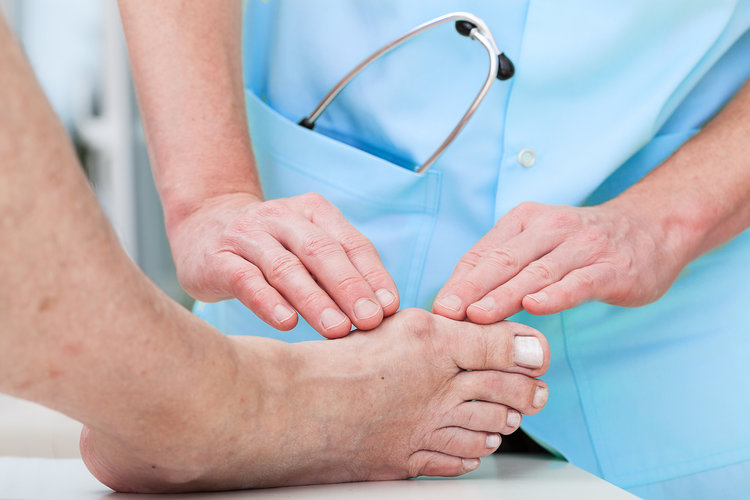 Biến chứng nguy hiểm của bệnh Gout có thể dẫn đến tàn phế, bạn biết chưa? Biến chứng nguy hiểm của bệnh Gout có thể dẫn đến tàn phế, bạn biết chưa?