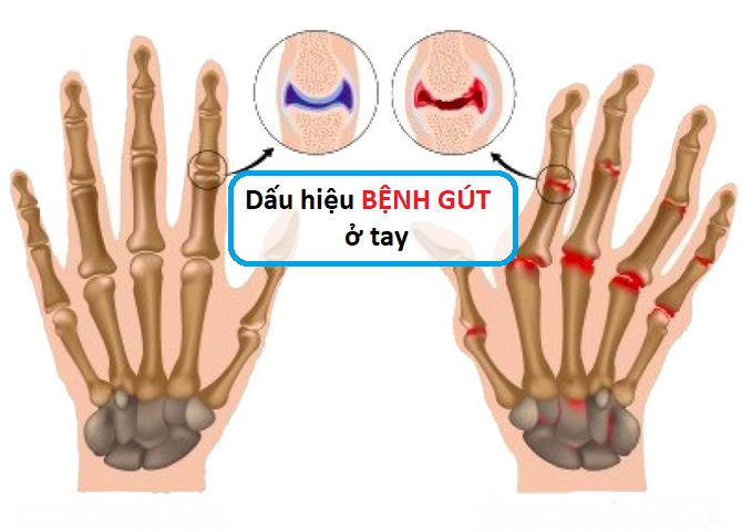 Bệnh Gout là gì? Bệnh Gout là gì?