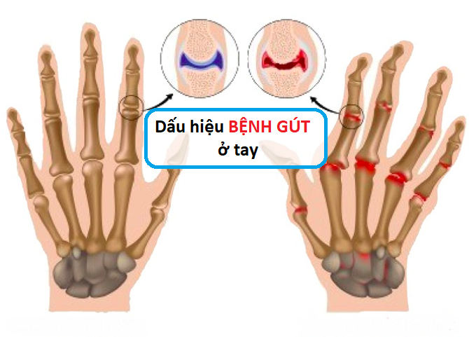 Bệnh Gout là gì?