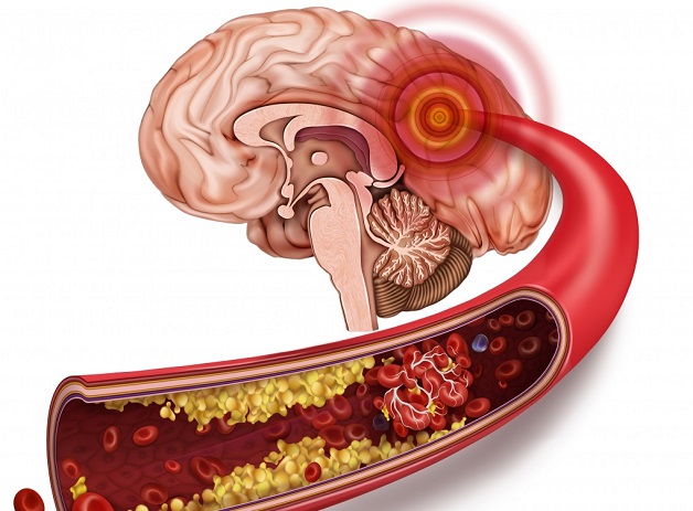 Những dấu hiệu tai biến mạch máu não từ nhẹ tới nặng