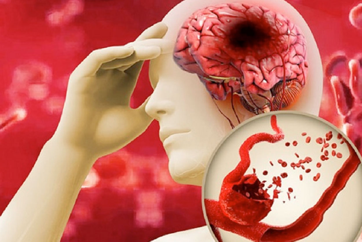 Đột quỵ ở người trẻ đang dần gia tăng Đột quỵ ở người trẻ đang dần gia tăng