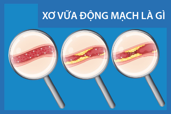 Xơ vữa động mạch là gì? Dấu hiệu, Nguyên Nhân, Triệu Chứng Xơ vữa động mạch là gì? Dấu hiệu, Nguyên Nhân, Triệu Chứng