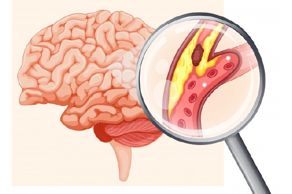 Những người dễ bị tai biến mạch máu não?