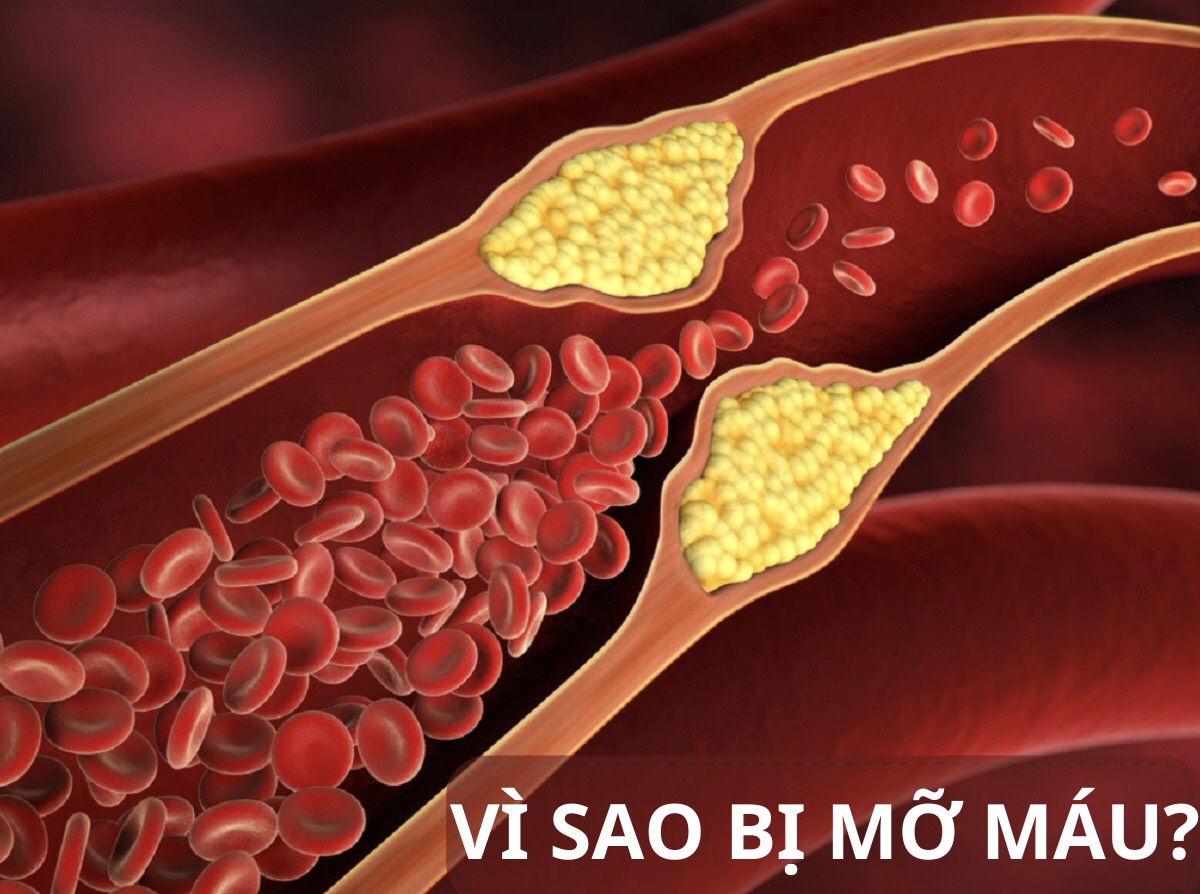 Vì sao bị mỡ máu?