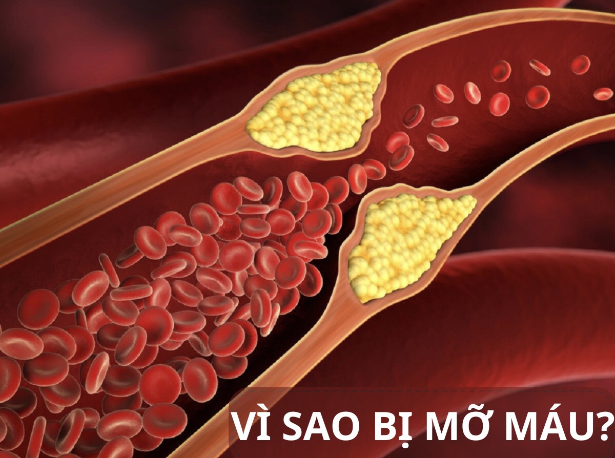 Vì sao bị mỡ máu? Vì sao bị mỡ máu?
