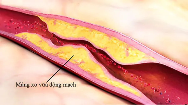 Xơ vữa động mạch cảnh có chữa được không? Các yếu tố gây bệnh