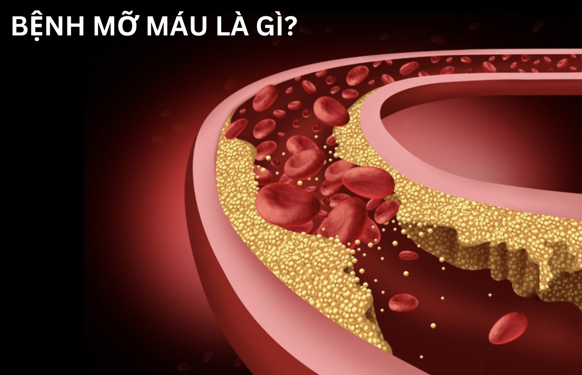 BỆNH MỠ MÁU LÀ GÌ? CÓ NGUY HIỂM KHÔNG? BỆNH MỠ MÁU LÀ GÌ? CÓ NGUY HIỂM KHÔNG?