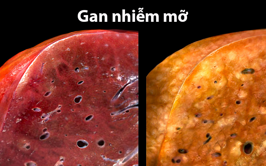 Gan nhiễm mỡ có nguy hiểm không? 5 biến chứng của bệnh gan nhiễm mỡ