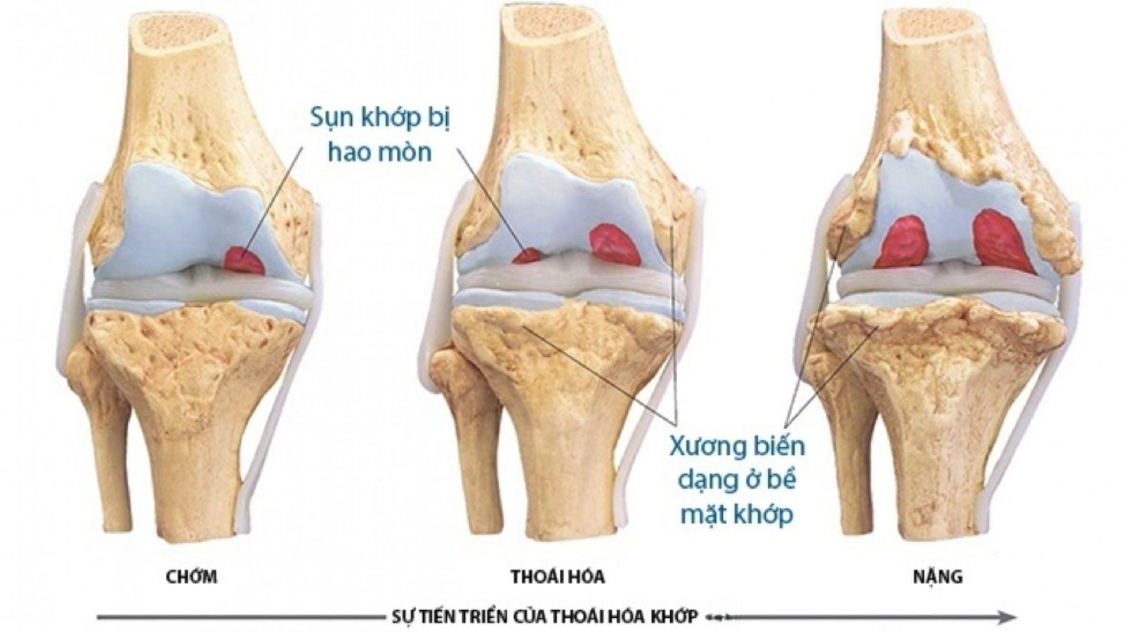 Nguyên nhân thoái hóa khớp