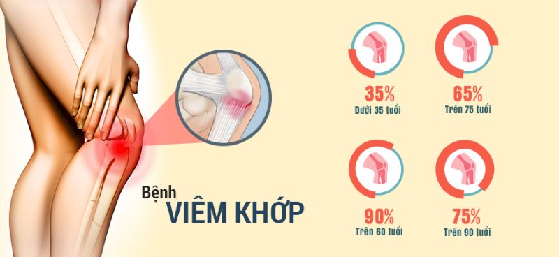 Glucosamine hỗ trợ điều trị bệnh viêm khớp hiệu quả