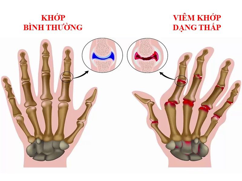Noxa 20 điều trị hiệu quả chứng viêm khớp dạng thấp và các bệnh xương khớp khác