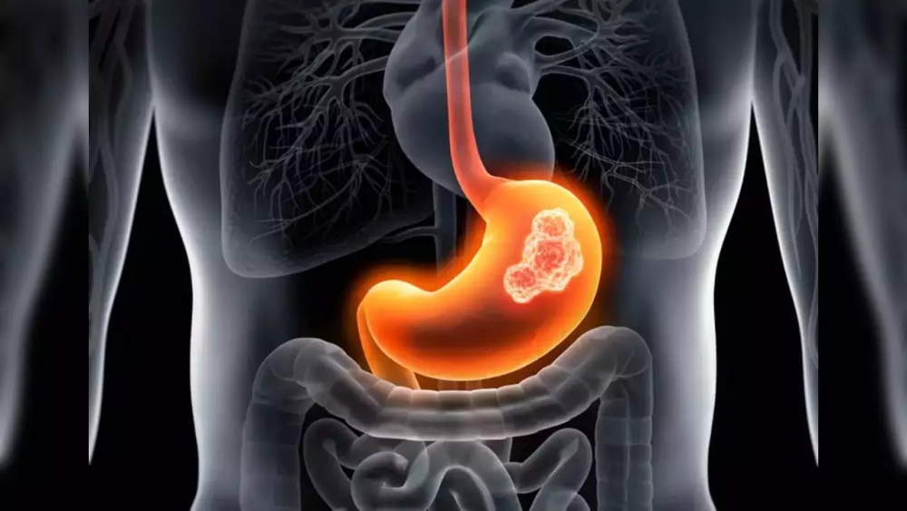 Nhận Biết Dấu Hiệu Của Bệnh Đau Dạ Dày: Triệu Chứng và Cách Phòng Ngừa