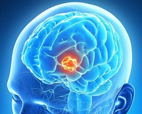 Tổng hợp các căn bệnh về não thường gặp