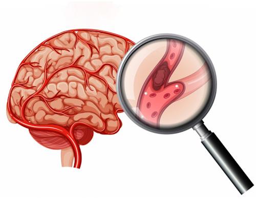 Cục máu đông trong não hình thành do đâu?
