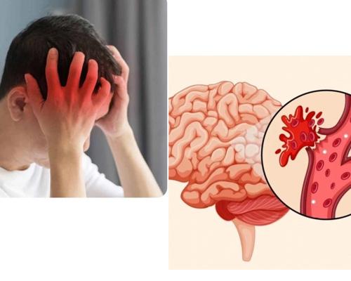 Dấu hiệu đột quỵ trước 30 ngày: Tổng hợp 7 triệu chứng phổ biến nhất