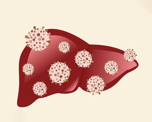 Dấu hiệu viêm gan C giai đoạn đầu là gì?