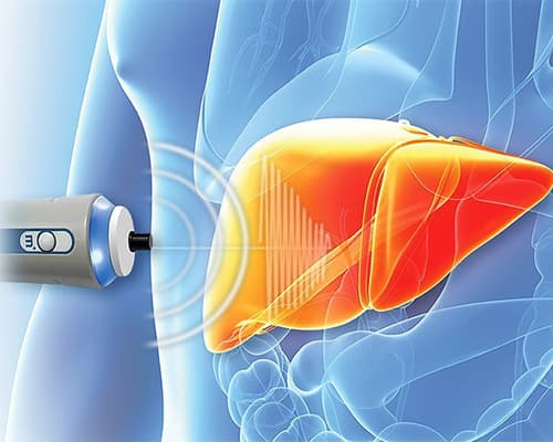 Đo độ đàn hồi gan là gì, khi nào cần thực hiện