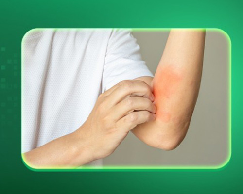 Gan nhiễm độc gây ngứa: Dấu hiệu gan tổn thương