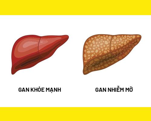 Gan nhiễm mỡ độ 3 là gì? Dấu hiệu cần lưu ý