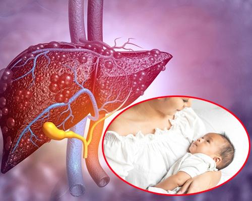 Gan nhiễm mỡ sau sinh có nguy hiểm không? Những điều mẹ cần biết