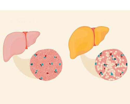 Gan thấm mỡ là gì và những điều cần biết?