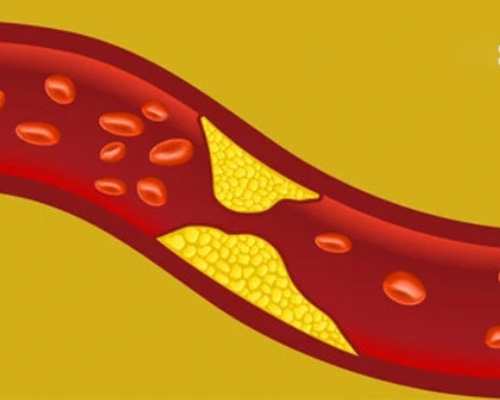 Giảm cholesterol là gì? Cách hạ mỡ máu an toàn và hiệu quả