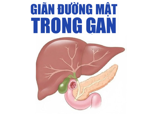 Giãn đường mật trong gan: Triệu chứng, nguyên nhân