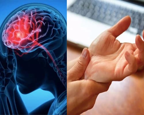 Huyết áp thấp có bị đột quỵ không? Dấu hiệu cảnh báo sớm