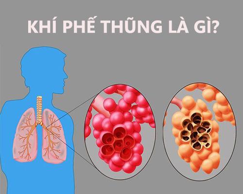 Khí phế thũng là gì? Nguyên nhân, triệu chứng bệnh