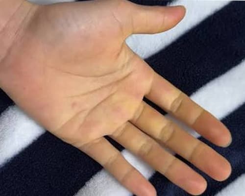 Lòng bàn tay vàng bị bệnh gì? Cảnh báo bệnh gan cần biết