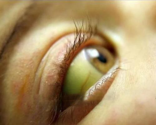 Mắt vàng bệnh gì? Nguyên nhân và dấu hiệu nhận biết sớm