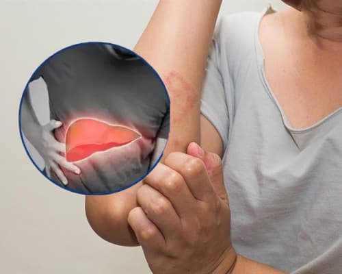 Ngứa dưới da có phải do bệnh gan? Dấu hiệu nhận biết