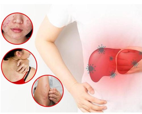 5 dấu hiệu nóng gan nổi mụn do rượu bia cần biết ngay