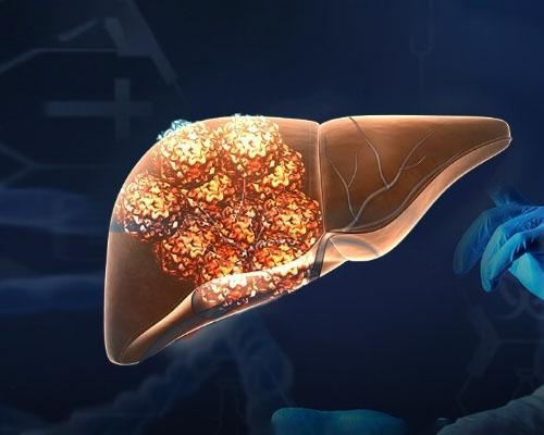 Làm thế nào để phòng ngừa ung thư gan hiệu quả nhất?