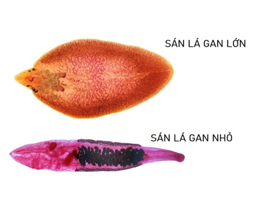Sán lá gan nhỏ là bệnh gì? Ai dễ mắc và cần khám khi nào?